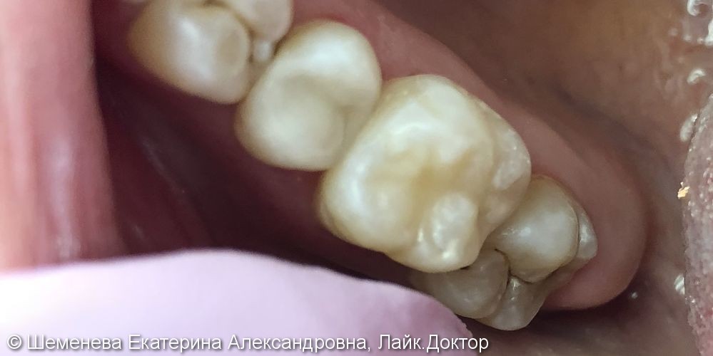 Хронический фиброзный пульпит зуба 1.5, глубокий кариес зуба 1.6 - фото №2