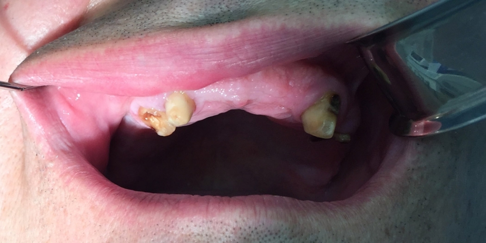 Имплантация зубов системой Osstem на верхнюю челюсть + протезирование - фото №1