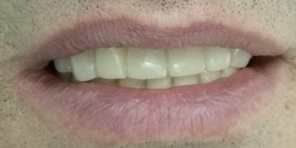 Имплантация зубов системой Osstem на верхнюю челюсть + протезирование - фото №2