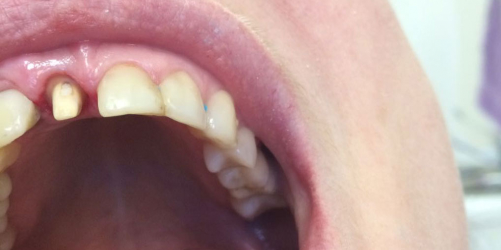 Реставрация фронтальной группы зубов безметалловыми коронками е-Мах - фото №1