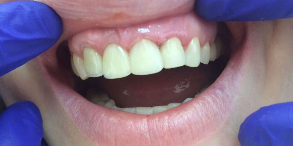 Реставрация фронтальной группы зубов безметалловыми коронками е-Мах - фото №2