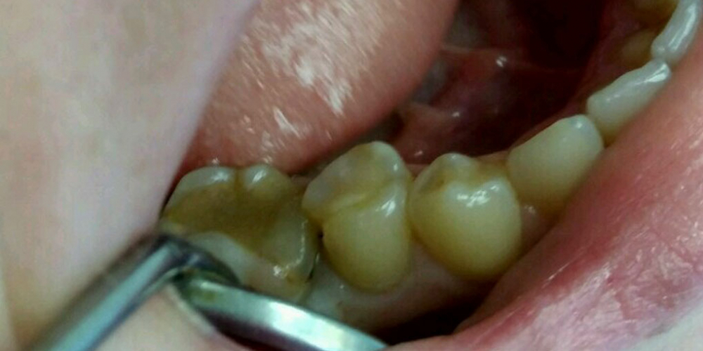 Лечение кариеса депульпрованного  зуба 45 с реставрацией анатомической формы материалом FiltekZ550 - фото №1