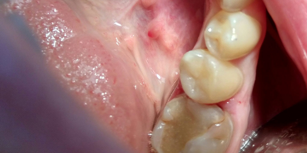 Лечение кариеса депульпрованного  зуба 45 с реставрацией анатомической формы материалом FiltekZ550 - фото №2