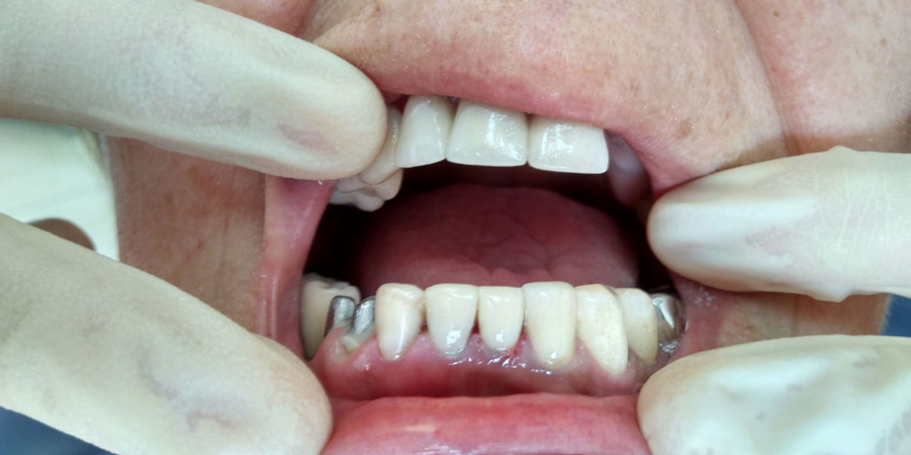 Реставрация зубов трех зубов материалом FiltekZ550 - фото №2