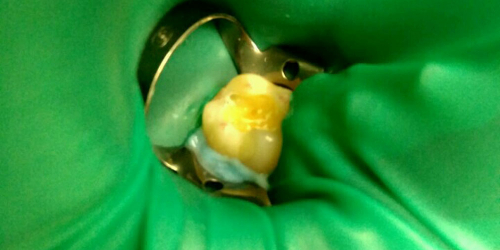 Лечение кариеса на жевательном зубе материалом FiltekZ550 - фото №1