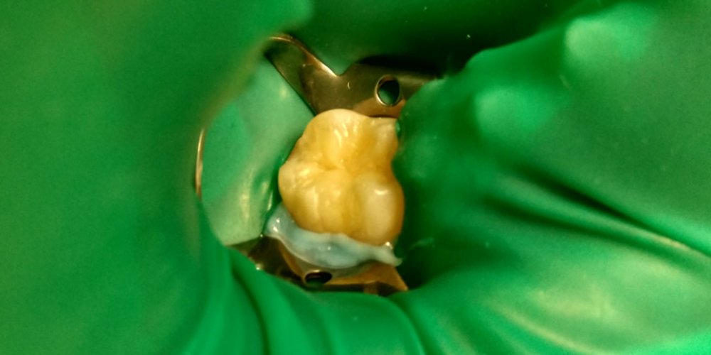Лечение кариеса на жевательном зубе материалом FiltekZ550 - фото №2