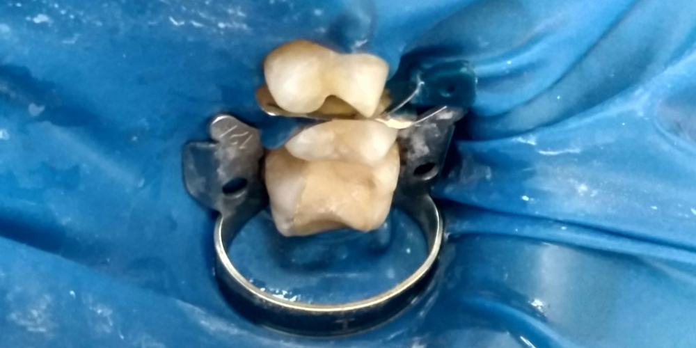 Лечение глубокого кариеса зубов 24,25, реставрация материалом FiltekZ550 - фото №1