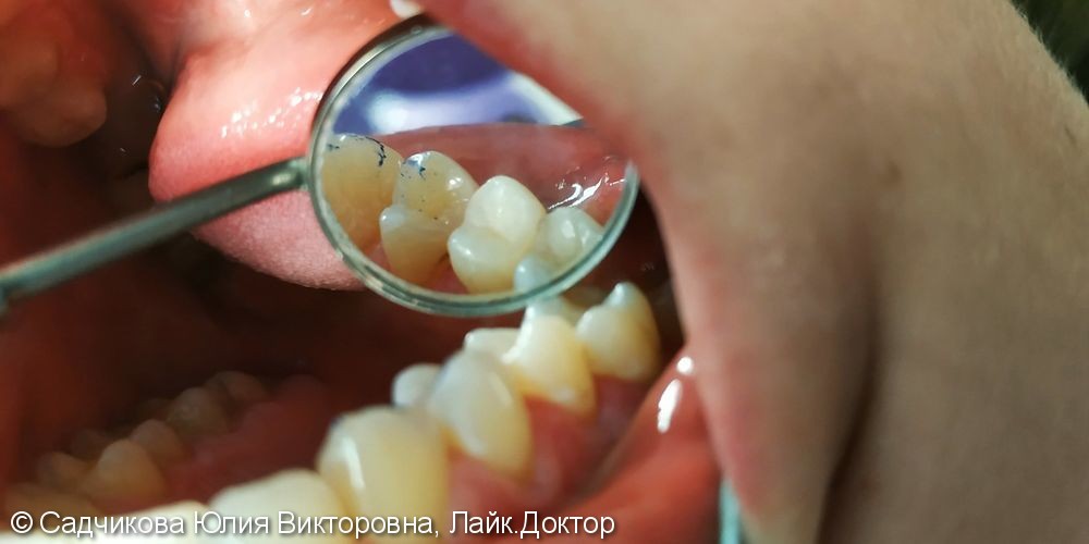 Лечение кариеса зуб 15, фото до и после - фото №3
