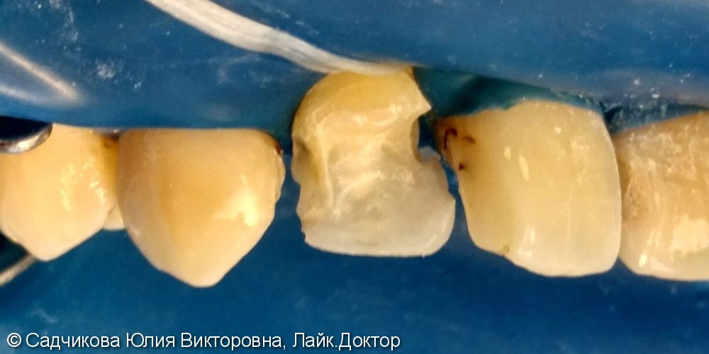 Реставрация фронтальной группы зубов, перелечивание корневых каналов - фото №1