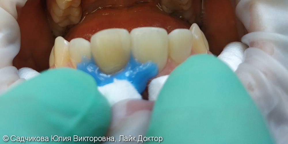 Реставрация фронтальной группы зубов, перелечивание корневых каналов - фото №3