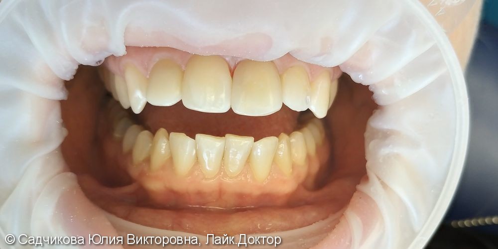 Реставрация фронтальной группы зубов, перелечивание корневых каналов - фото №4