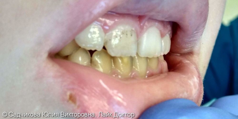 Профессиональная гигиена полости рта, налет Пристли (черные зубы), до и после - фото №1
