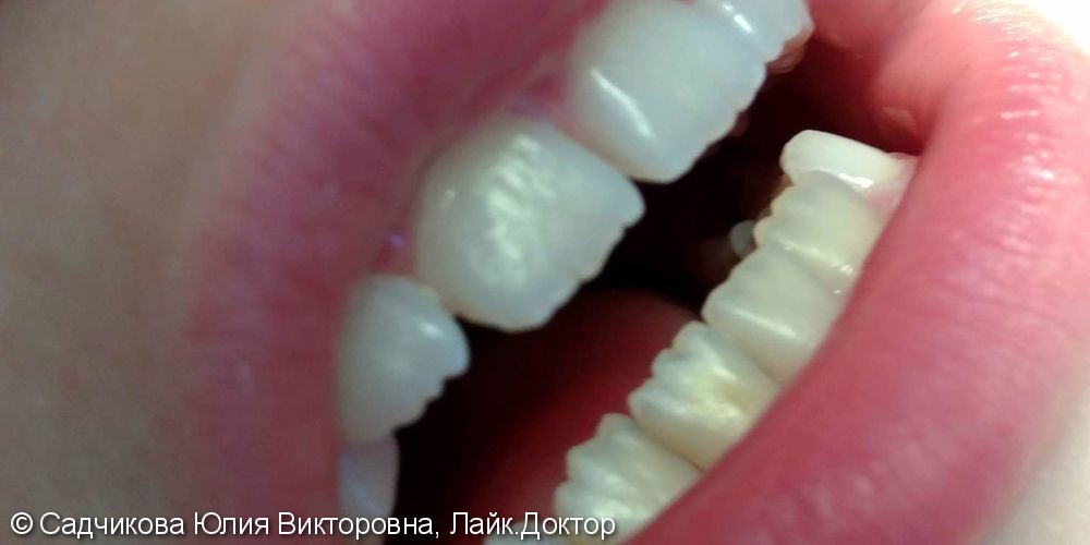 Профессиональная гигиена полости рта, налет Пристли (черные зубы), до и после - фото №3