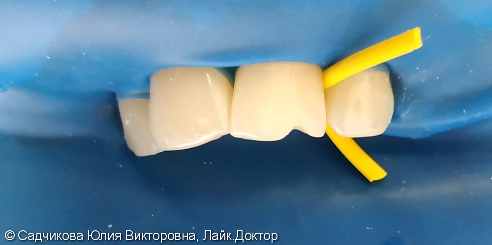 Реставрация дефекта переднего зуба от семечек, до и после - фото №1