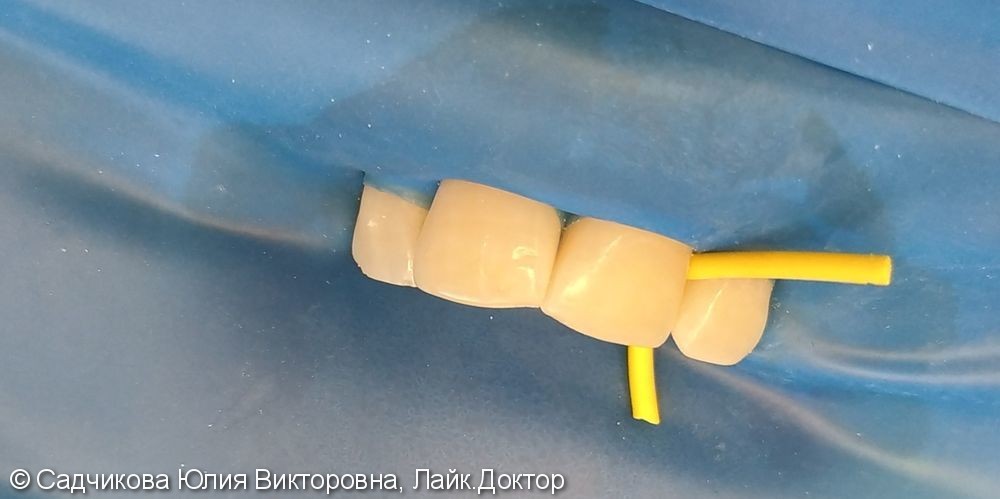 Реставрация дефекта переднего зуба от семечек, до и после - фото №2