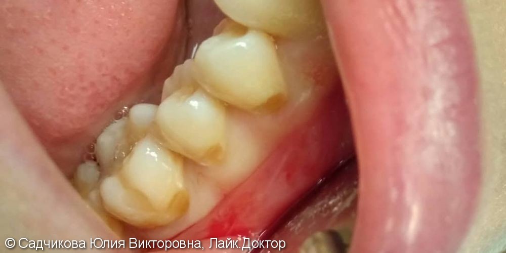 Клиновидные дефекты зубов 44, 45, 46, до и после лечения - фото №1