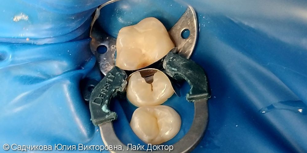Лечение кариеса жевательной группы зубов, до и после - фото №1