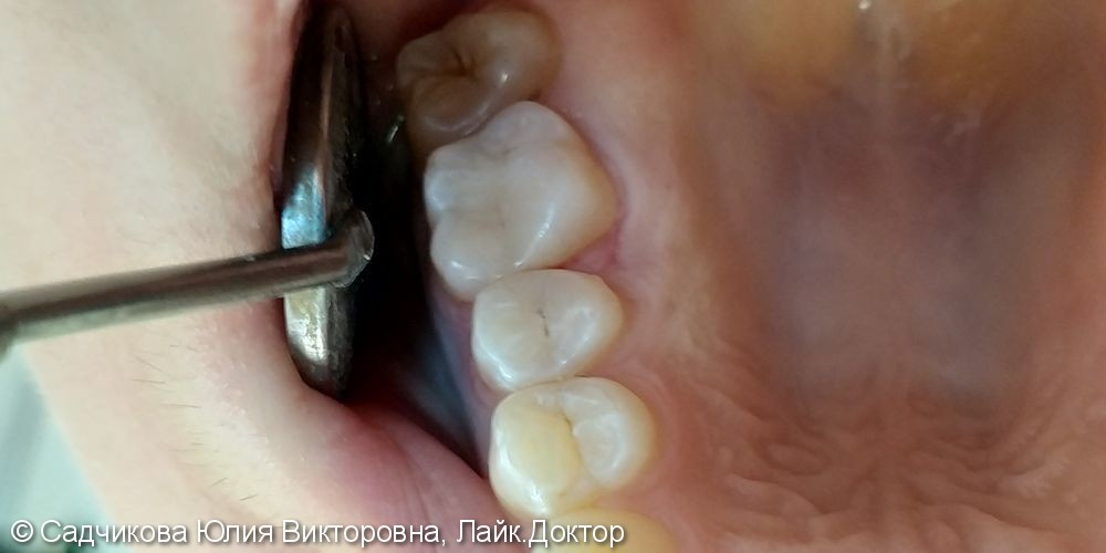 Лечение кариеса жевательной группы зубов, до и после - фото №3