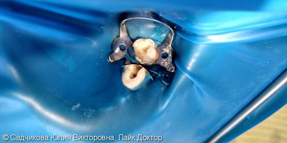 Лечение пульпита и кариеса молочных зубов, результат до и после лечения - фото №1