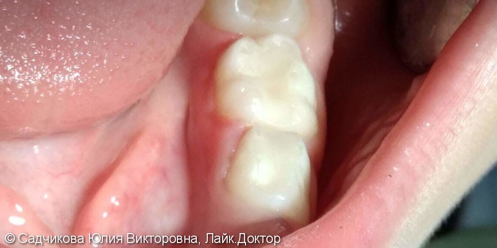 Лечение пульпита и кариеса молочных зубов, результат до и после лечения - фото №2