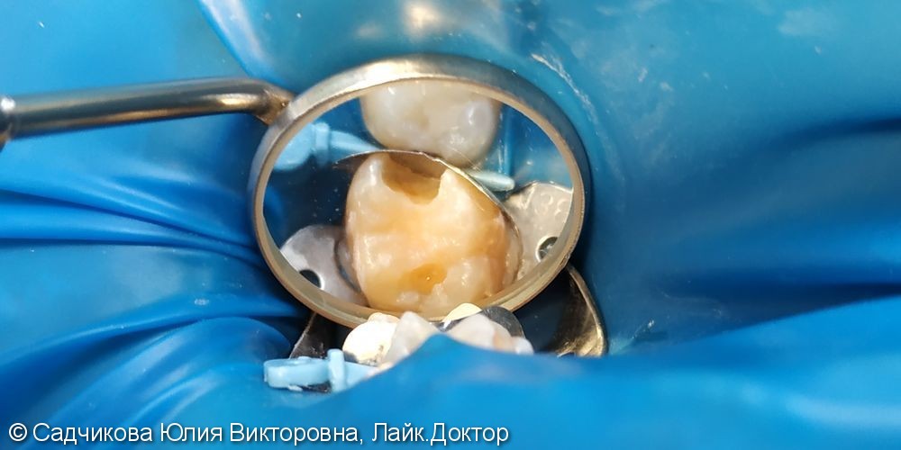 Лечение кариеса постоянного зуба у ребенка 14 лет - фото №1