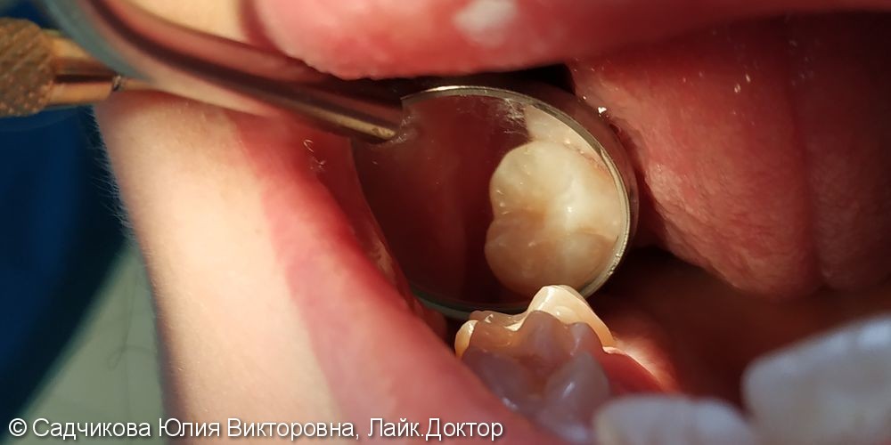 Лечение кариеса постоянного зуба у ребенка 14 лет - фото №2