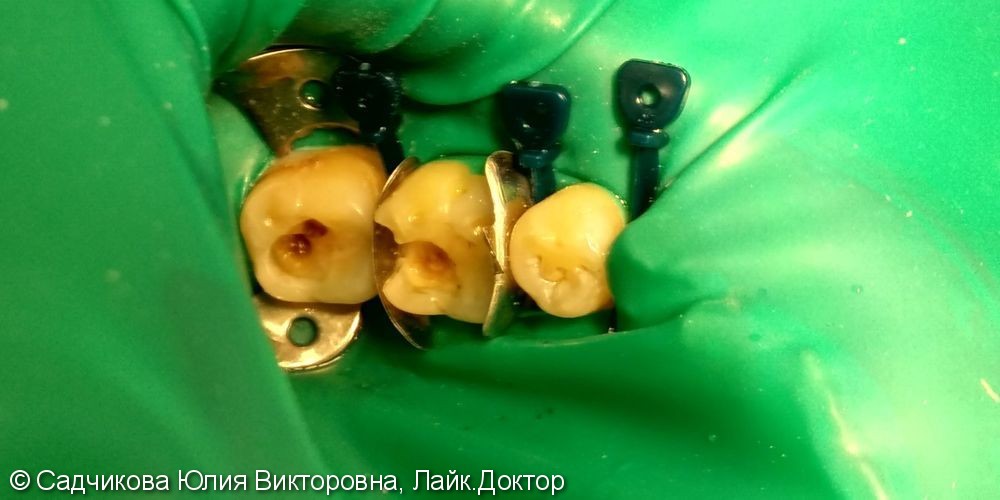 Лечение кариеса двух зубов 36, 37 в одно посещение, до и после - фото №1