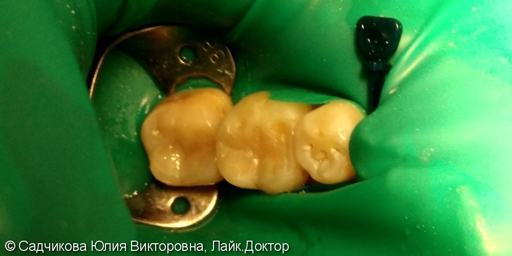 Лечение кариеса двух зубов 36, 37 в одно посещение, до и после - фото №2