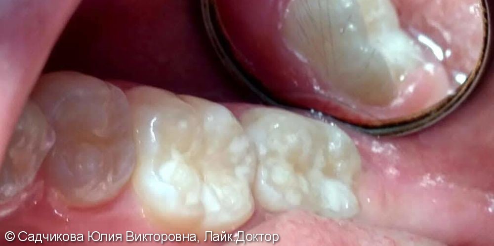 Лечение кариеса постоянного зуба 47 - фото №2