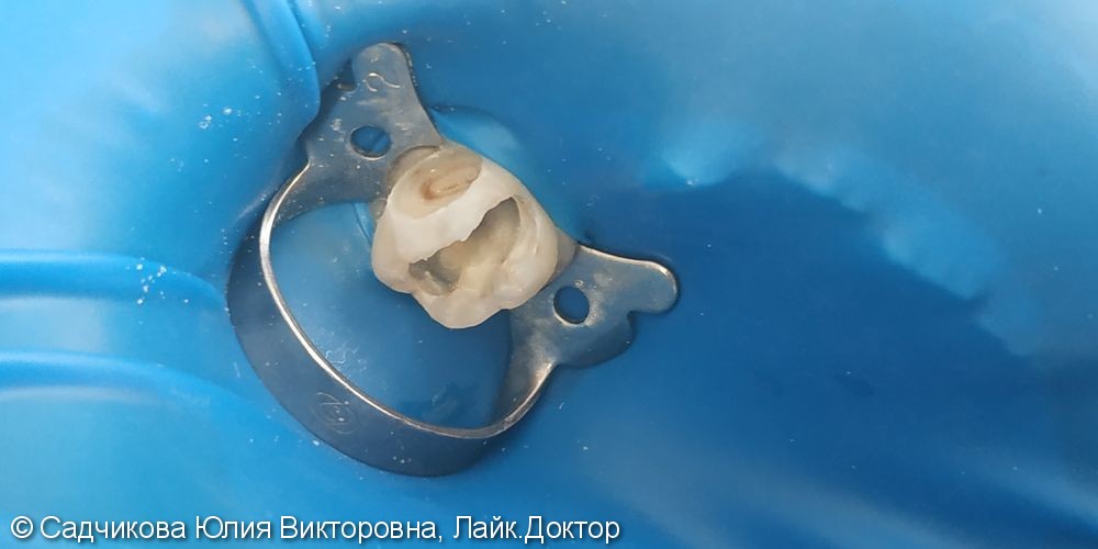 Лечение пульпита молочного зуба - фото №1
