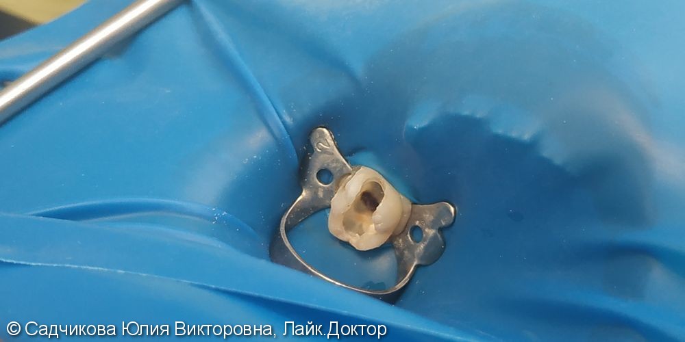 Лечение пульпита молочного зуба - фото №2