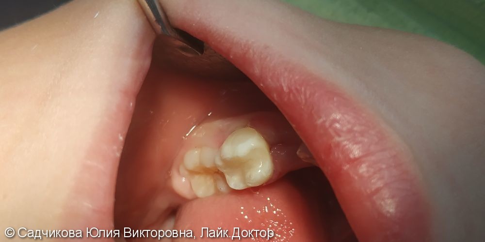 Лечение пульпита молочного зуба - фото №3