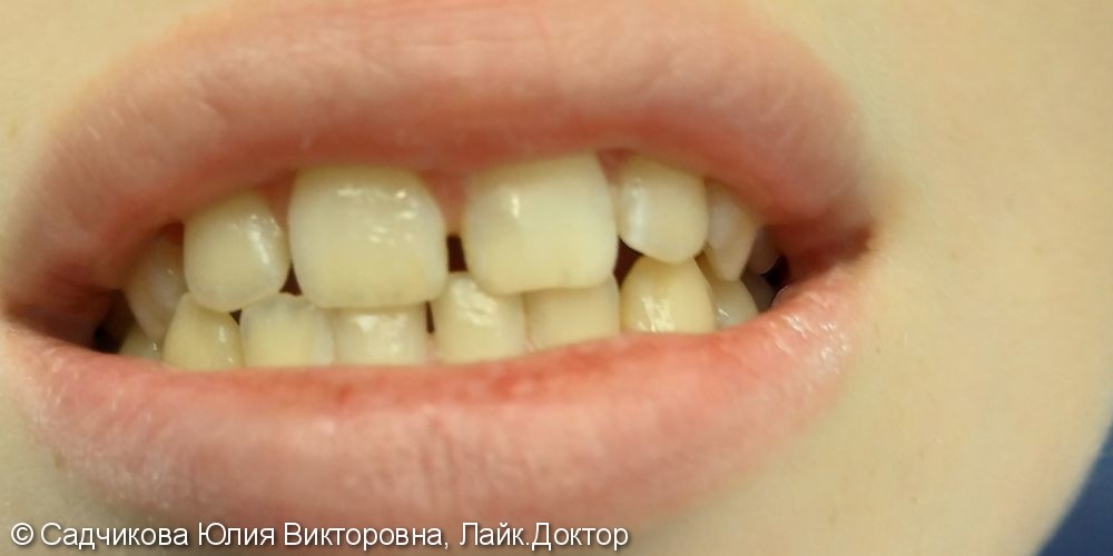 Откололи кусочек переднего зуба у ребенка - фото №2