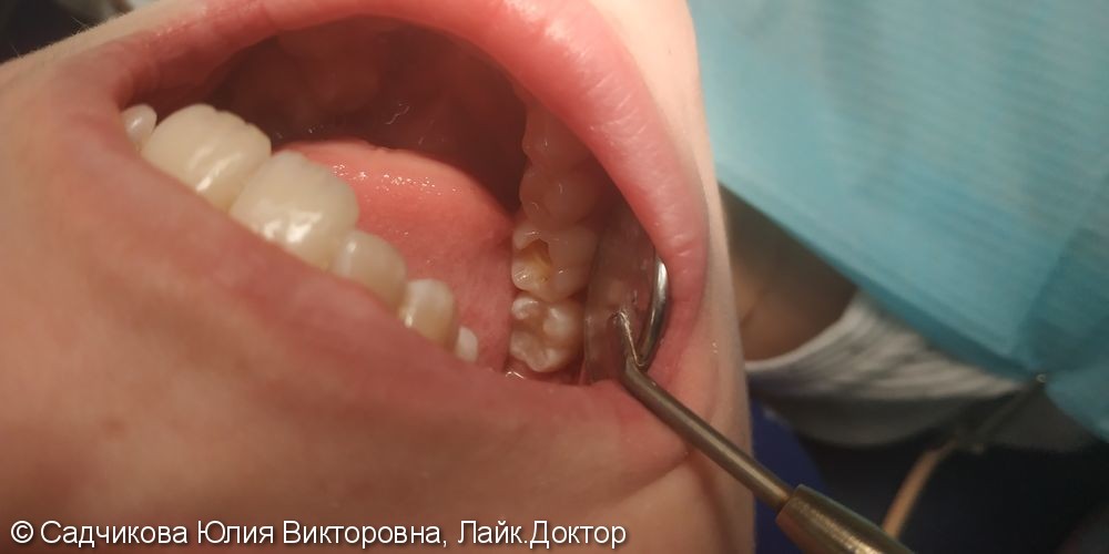 Лечение кариеса зубов 46, 47 материалом Церам Сфертек - фото №2