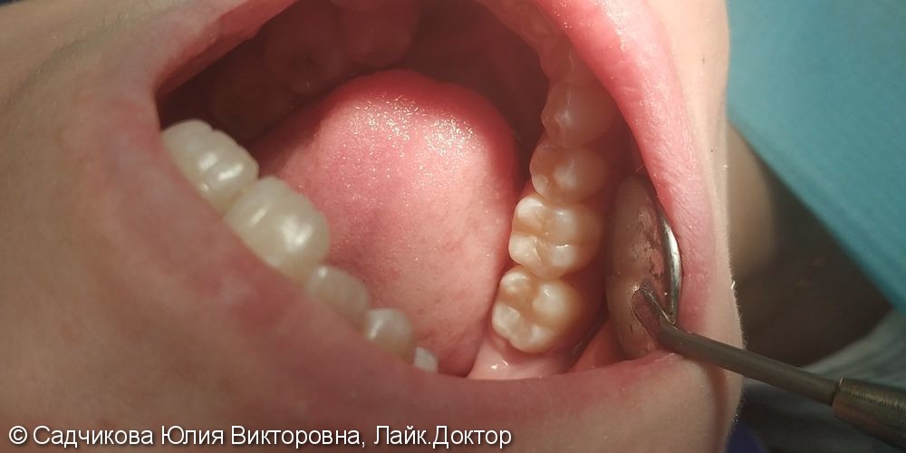 Лечение кариеса зубов 46, 47 материалом Церам Сфертек - фото №3