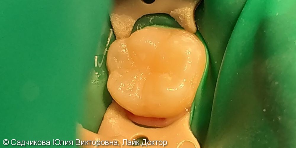 Лечение кариеса постоянного зуба 36 у ребенка 6 лет - фото №2
