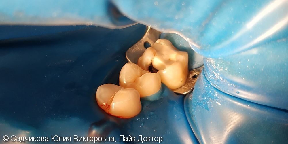 Лечение глубокого кариеса постоянного зуба 16 - фото №1