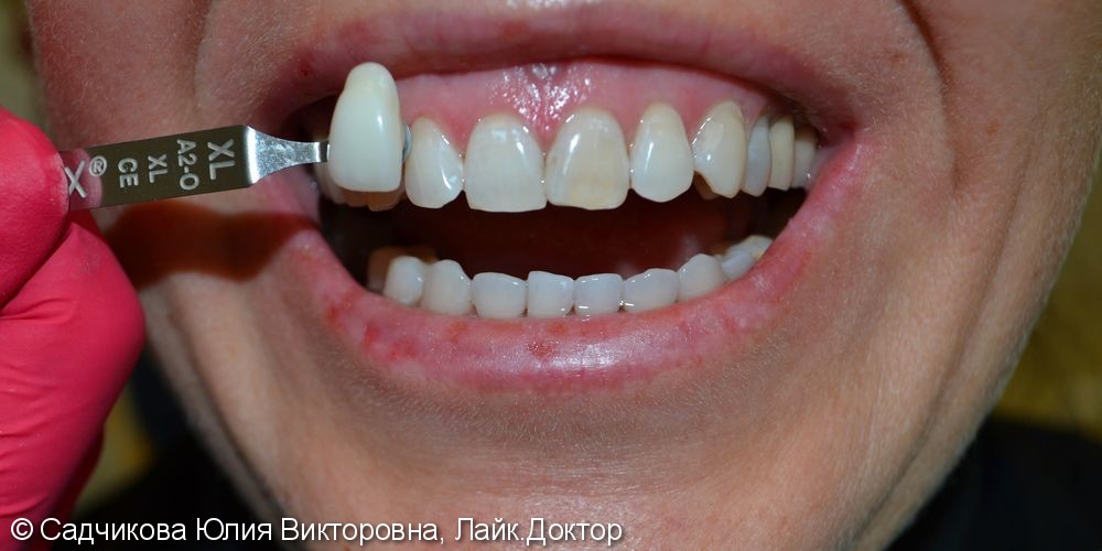 Отбеливание зубов системой ZOOM, до и результат после - фото №2