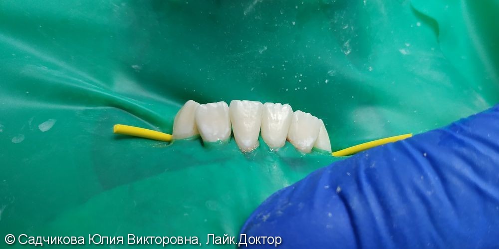Лечение кариеса нижних передних зубов - фото №2