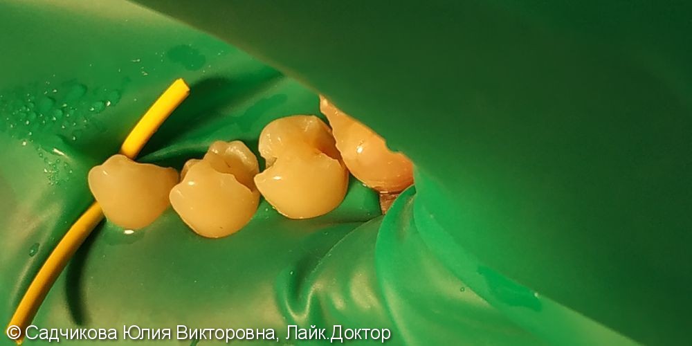 Лечение глубокого кариеса зубов 34, 35, до и после лечения - фото №1