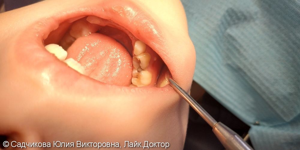 Лечение пульпита молочного зуба и удаление молочного зуба - фото №1