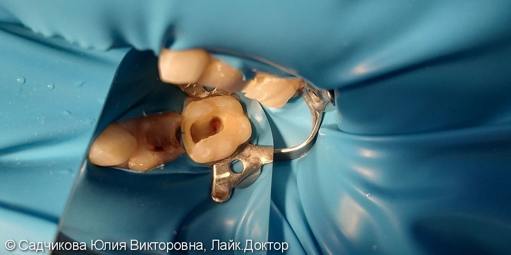 Лечение пульпита молочного зуба и удаление молочного зуба - фото №2