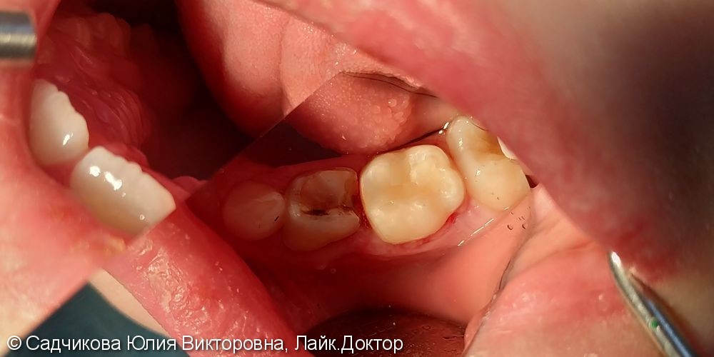 Лечение пульпита молочного зуба и удаление молочного зуба - фото №3
