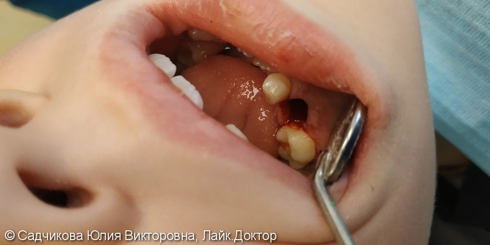 Лечение пульпита молочного зуба и удаление молочного зуба - фото №5