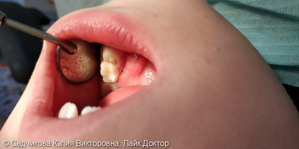 Лечение пульпита молочного зуба / удаление - фото №3