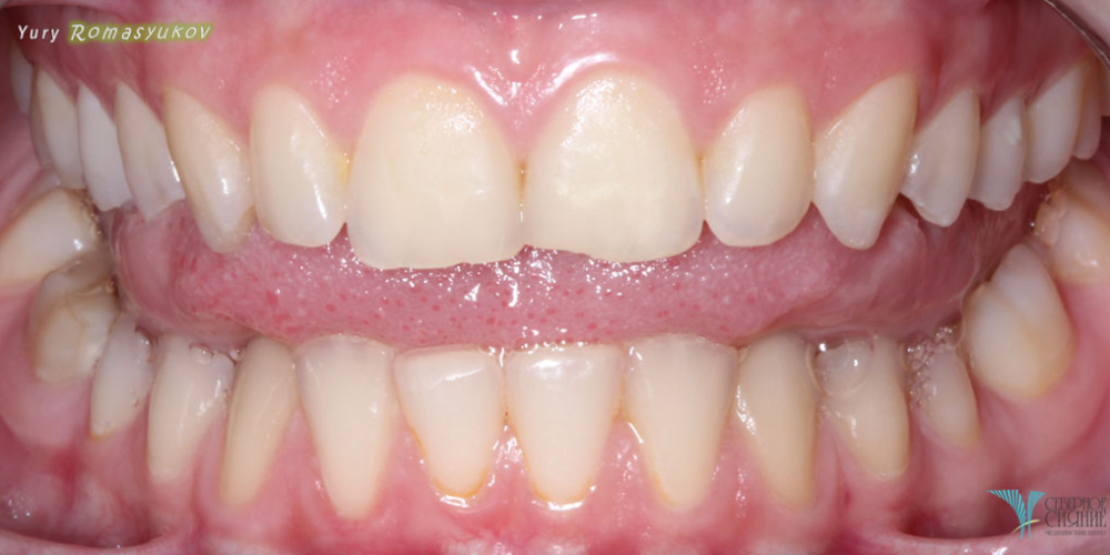 Результат отбеливания зубов системой Opalescence - фото №1