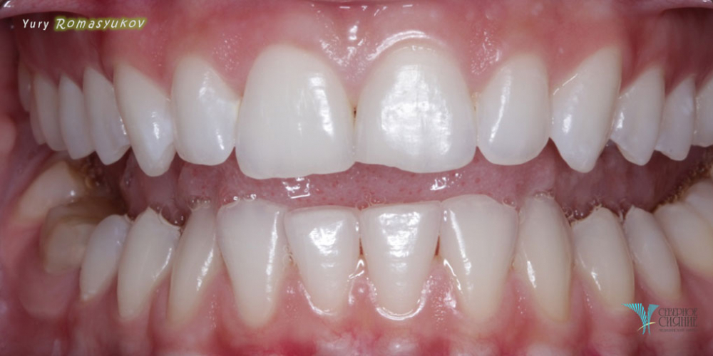 Результат отбеливания зубов системой Opalescence - фото №2