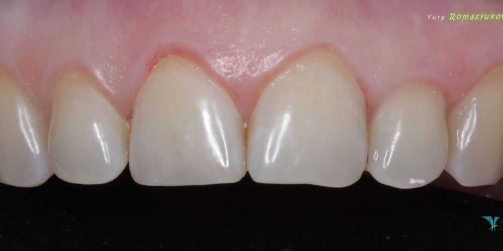 Востановление скола зуба, центрального резца - фото №2