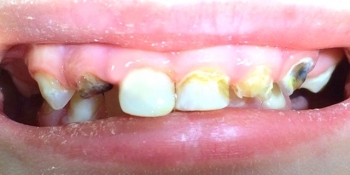 Восстановление целостности молочных зубов Strip-коронками - фото №1