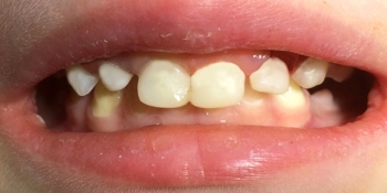 Восстановление целостности молочных зубов Strip-коронками - фото №2